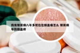我有銀屑病八年多現(xiàn)在左膝蓋痛怎么 銀屑病導(dǎo)致膝蓋疼