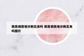 銀屑病很難診斷出來嗎 銀屑病很難診斷出來嗎圖片