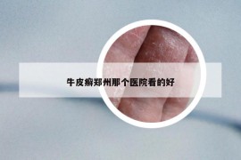 牛皮癬鄭州那個醫(yī)院看的好