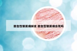 膿包性銀屑病掉皮 膿包型銀屑病會死嗎