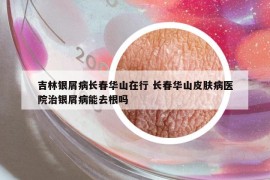 吉林銀屑病長(zhǎng)春華山在行 長(zhǎng)春華山皮膚病醫(yī)院治銀屑病能去根嗎