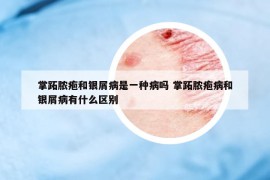 掌跖膿皰和銀屑病是一種病嗎 掌跖膿皰病和銀屑病有什么區(qū)別
