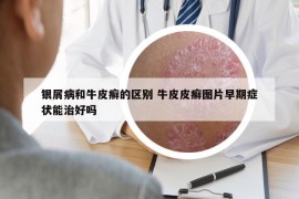 銀屑病和牛皮癬的區(qū)別 牛皮皮癬圖片早期癥狀能治好嗎