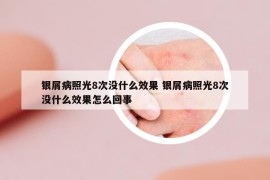 銀屑病照光8次沒什么效果 銀屑病照光8次沒什么效果怎么回事