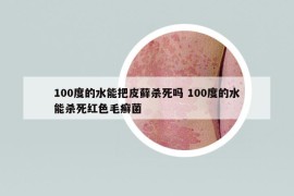 100度的水能把皮蘚殺死嗎 100度的水能殺死紅色毛癬菌