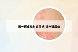 溫一醫(yī)皮膚科銀屑病 溫州銀屑病