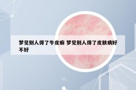夢(mèng)見別人得了牛皮癬 夢(mèng)見別人得了皮膚病好不好