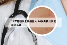 14歲男孩頭上長癬圖片 14歲男孩長頭皮屑怎么辦