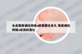 頭皮銀屑病吃阿維a膠囊要吃多久 銀屑病吃阿維a皮損的變化