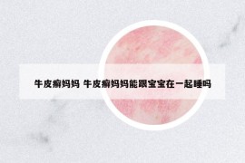 牛皮癬媽媽 牛皮癬媽媽能跟寶寶在一起睡嗎