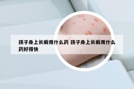 孩子身上長癬用什么藥 孩子身上長癬用什么藥好得快