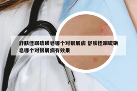 舒膚佳跟硫磺皂哪個(gè)對(duì)銀屑病 舒膚佳跟硫磺皂哪個(gè)對(duì)銀屑病有效果