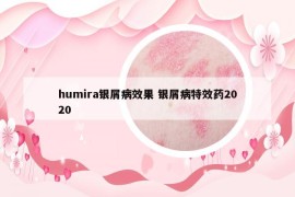 humira銀屑病效果 銀屑病特效藥2020
