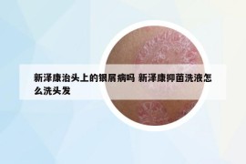 新澤康治頭上的銀屑病嗎 新澤康抑菌洗液怎么洗頭發(fā)