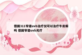 德國311窄譜uvb治療儀可以治療牛皮癬嗎 德國窄譜uvb光療