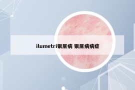 ilumetri銀屑病 銀屑病病癥