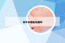 有牛皮癬能出國嗎