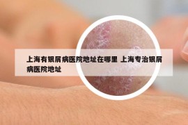 上海有銀屑病醫(yī)院地址在哪里 上海專治銀屑病醫(yī)院地址