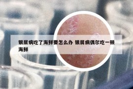銀屑病吃了海鮮要怎么辦 銀屑病偶爾吃一頓海鮮
