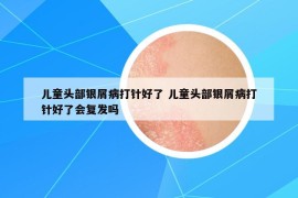兒童頭部銀屑病打針好了 兒童頭部銀屑病打針好了會(huì)復(fù)發(fā)嗎