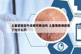 兒童感冒后牛皮癬可根治嗎 兒童銀屑病感冒了吃什么藥