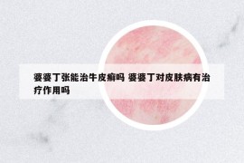婆婆丁張能治牛皮癬嗎 婆婆丁對(duì)皮膚病有治療作用嗎