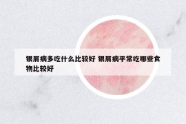 銀屑病多吃什么比較好 銀屑病平常吃哪些食物比較好