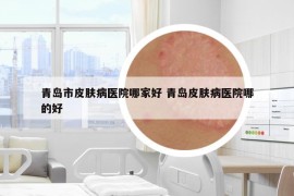 青島市皮膚病醫(yī)院哪家好 青島皮膚病醫(yī)院哪的好