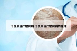 干擾素治療銀屑病 干擾素治療銀屑病的原理