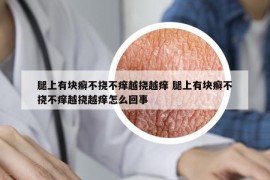 腿上有塊癬不撓不癢越撓越癢 腿上有塊癬不撓不癢越撓越癢怎么回事