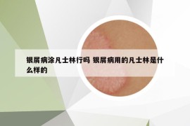 銀屑病涂凡士林行嗎 銀屑病用的凡士林是什么樣的