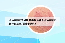 卡泊三醇能治好銀屑病嗎 為什么卡泊三醇能治療銀屑病?是激素藥嗎?
