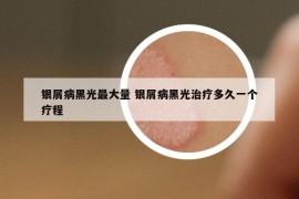 銀屑病黑光最大量 銀屑病黑光治療多久一個(gè)療程
