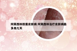 阿莫西林膠囊皮膚病 阿莫西林治療皮膚病最多用幾天