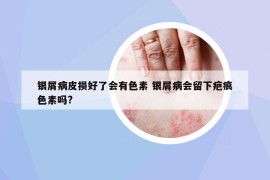 銀屑病皮損好了會有色素 銀屑病會留下疤痕色素嗎?