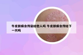 牛皮膚癬會(huì)傳染給他人嗎 牛皮膚癬會(huì)傳給下一代嗎