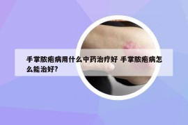 手掌膿皰病用什么中藥治療好 手掌膿皰病怎么能治好?