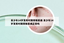 青少年14歲發(fā)育時(shí)期得銀屑病 青少年14歲發(fā)育時(shí)期得銀屑病正常嗎