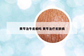 黃芩治牛皮癬嗎 黃芩治療皮膚病