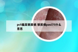 pct偏高銀屑病 銀屑病pasi75什么意思