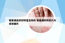 銀屑病逐步好轉(zhuǎn)是怎樣的 銀屑病好轉(zhuǎn)的六大癥狀圖片