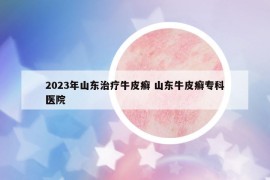 2023年山東治療牛皮癬 山東牛皮癬?？漆t(yī)院