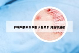 腳踝響和銀屑病有沒有關(guān)系 腳腕銀屑病