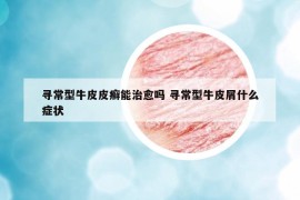 尋常型牛皮皮癬能治愈嗎 尋常型牛皮屑什么癥狀