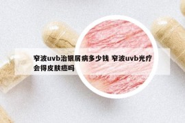 窄波uvb治銀屑病多少錢(qián) 窄波uvb光療會(huì)得皮膚癌嗎
