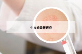 牛皮癬最新研究