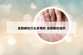 皮膚癬吃什么食物好 皮膚癬吃啥藥