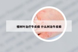 楮樹葉治療牛皮癬 什么樹治牛皮癬