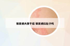 銀屑病大便干結(jié) 銀屑病拉肚子嗎