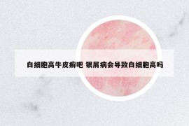 白細胞高牛皮癬吧 銀屑病會導致白細胞高嗎